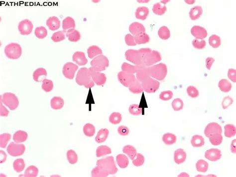 [RBC AGGLUTINATION].The red cell agglutinates may be small or large and few to numerous ...