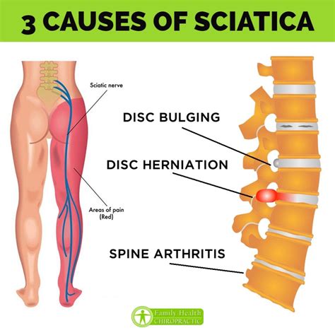 Austin Chiropractor | Sciatica Treatment in Austin Texas