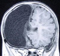 Hemispherectomy: What It Is, Procedure & Side Effects