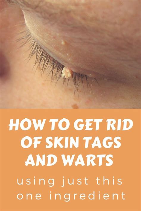 How to get rid of skin tags and warts using just this one ingredient - Have you ever tried this ...