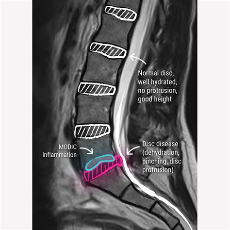 Degenerative Disc Disease - CCV Montpellier