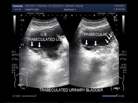 A Trabeculated urinary bladder, patient aged 60 years. - YouTube