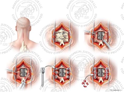 C3-5 Posterior Cervical Laminectomy and Fusion - No Text