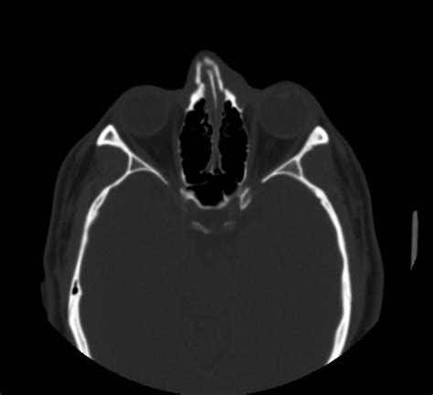 Nasal bone fracture - wikidoc