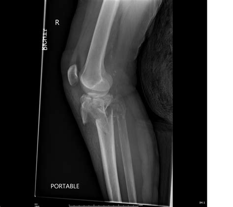 Aspirer intersection Soulager fracture plateau tibial kiné violation Apte Changement