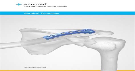 Locking Clavicle Plating System - Acumed · Superior Midshaft Plate Surgical Technique [continued ...