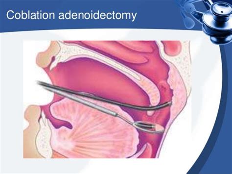 Adenoidectomy