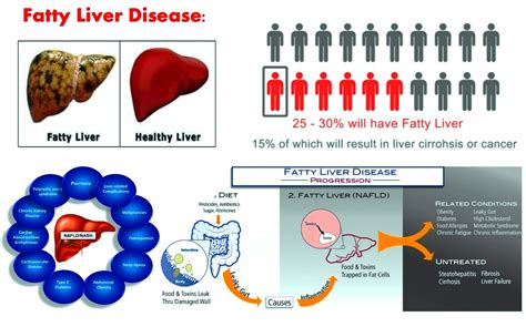 What is Fatty Liver (Steatosis)? - Fatty Liver Remedy