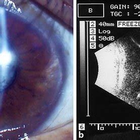 Preoperative clinical findings. a Slit lamp examination revealed the ...