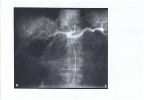 Celiac Trunk Angiogram Diagram | Quizlet