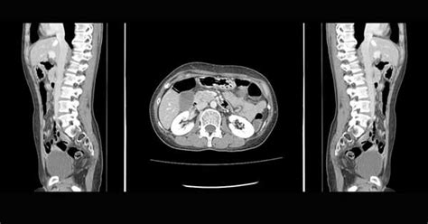 Tomografía computarizada de abdomen y pelvis, lo que debes saber