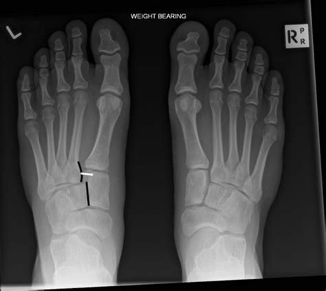 A painful foot: Lisfranc fracture-dislocations | The BMJ