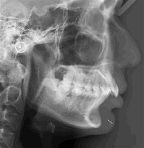 Susuk or charm needle: a strange object detected on orthodontic diagnostic radiographs | BMJ ...