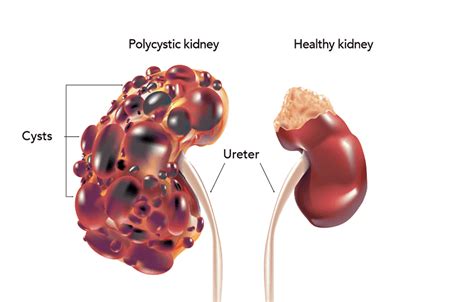 PKD | PKD Ayurvedic Treatment | Can It Enable A Normal Life?