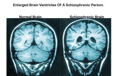 Image result for disconnection in the brain of schizophrenic ...