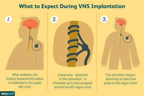 Vagus Nerve Electrical Stimulation