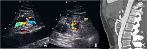 Superior Mesenteric Vein Ultrasound