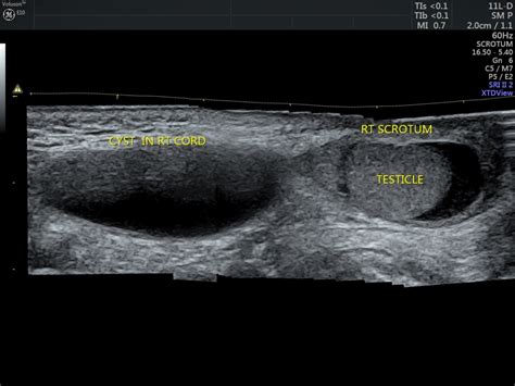 SPERMATIC CORD HYDROCELE | Looking Through a Transducer