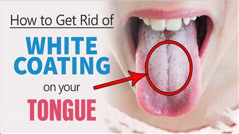 How To Get Rid Of Coated Tongue || Home Remedies for White Coated Tongue - YouTube