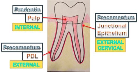 External Resorption Of Tooth