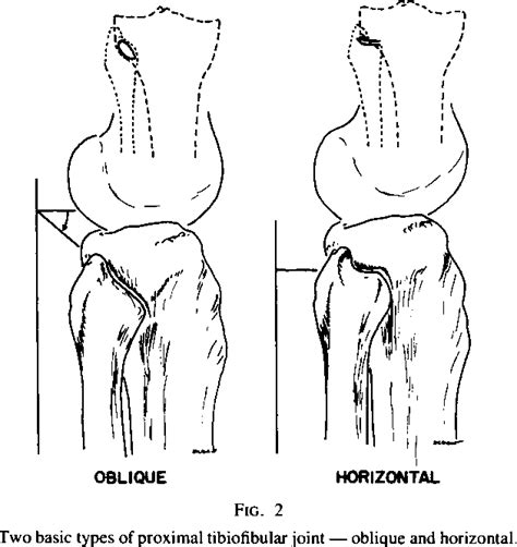 Figure 2 from Subluxation and dislocation of the proximal tibiofibular joint. | Semantic Scholar