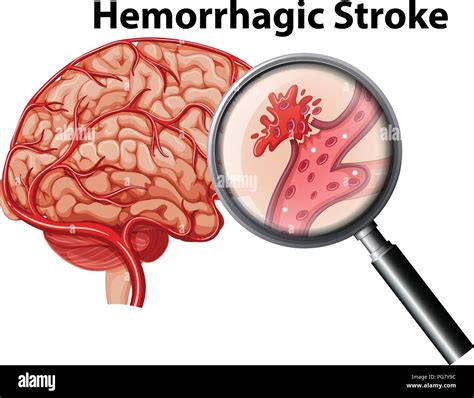 A human anatomy hemorrhagic stroke illustration Stock Vector Image & Art - Alamy