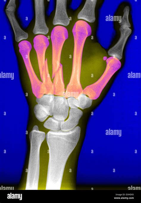 FRACTURED HAND, X-RAY Stock Photo - Alamy