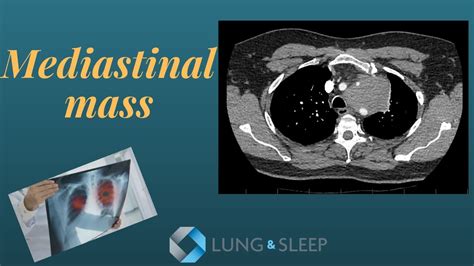 Mediastinal mass - what is the cause? Lymphoma, small cell carcinoma ...