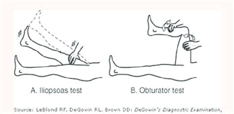 Positive Psoas and Obturator Signs [64]. | Download Scientific Diagram