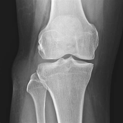 Ganglion cyst - knee | Image | Radiopaedia.org