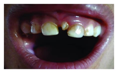 (a) Showing mesiodens in upper arch. (b) Radiograph showing rotated... | Download Scientific Diagram