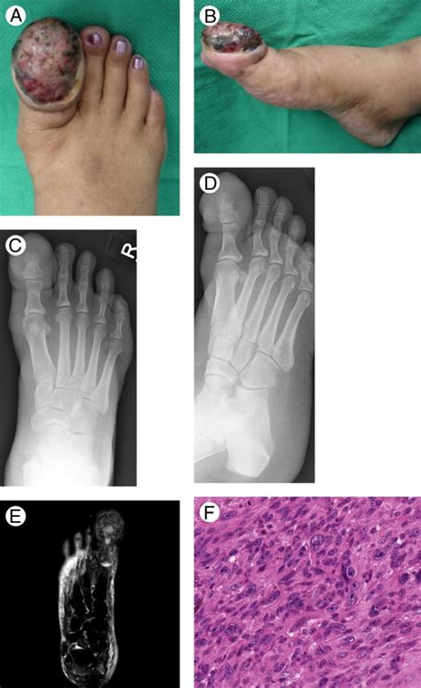 A Case Report of Malignant Melanoma of the Great Toe - The Journal of Foot and Ankle Surgery