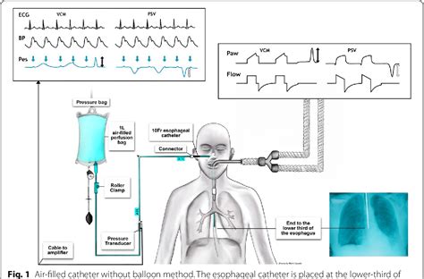 Figure 1 from Novel method of transpulmonary pressure measurement with an air-filled esophageal ...