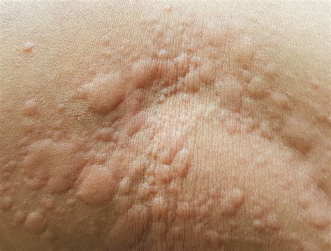 Herziene behandelrichtlijn Urticaria en angio-oedeem | Huisarts & Wetenschap