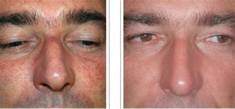 Treatment for broken blood vessels or facial capillaries - Lasermed: Laser Clinic & facial ...