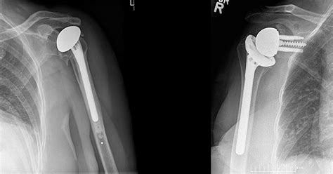 Total Shoulder Arthroplasty