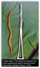 Eel Removed From Man’s Bladder–Entered Via His Penis While He Was At A ...