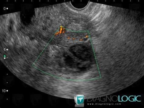 Cas radiologie : Abcès tubo ovarien (Echographie ,Scanner ,IRM) - Diagnologic