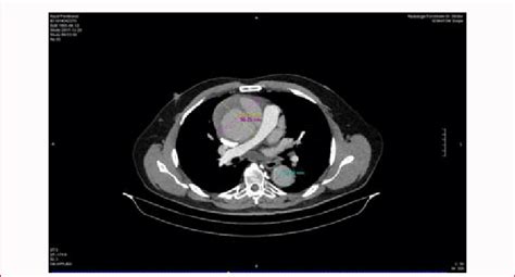 Pre-OP CT-Scan: Axial: Ascending and descending aorta. | Download Scientific Diagram