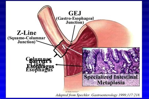 Barrett's esophagus; guidelines & new endoscopic techniques