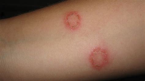 Ringworm: Treat Naturally with Neem Oil - JustNeem