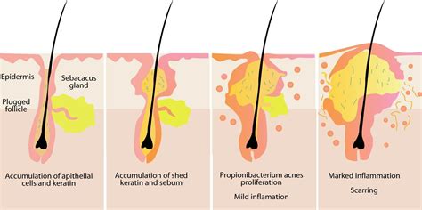 What Causes Acne and Natural Solutions | Arten von akne, Akne, Pickel heilmittel