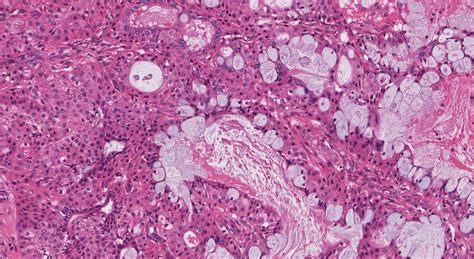 Mucoepidermoid carcinoma | Ottawa Atlas of Pathology