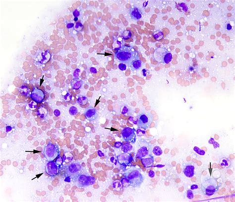 Anaplastic Large Cell Lymphoma Involving the Bone Marrow - 1.