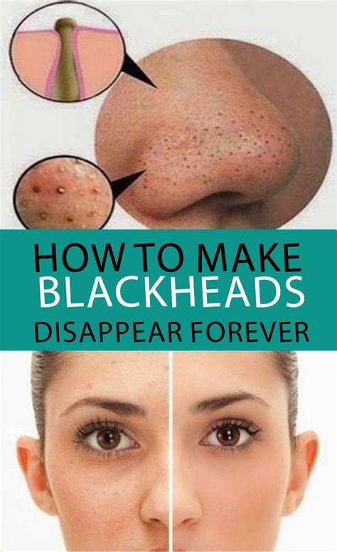 Some effective ways for getting rid of pores and blackheads on the face ...