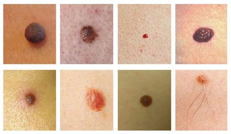 Teleconsultation for Mole Removal and Skin Cancer (Melanoma) - The ...