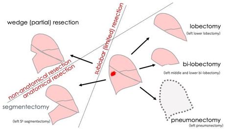 Sublobar Resections for Early Lung Cancer - ILCN.org (ILCN/WCLC)