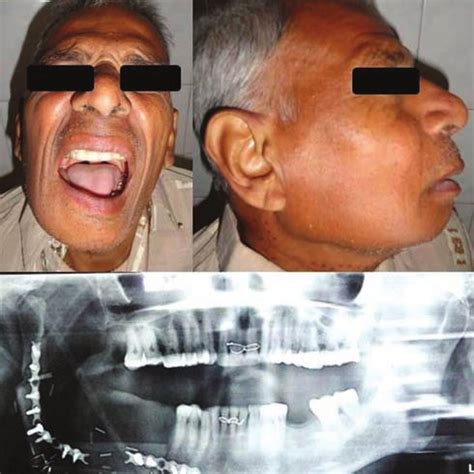 Postoperative results after ramus and body reconstruction. | Download ...