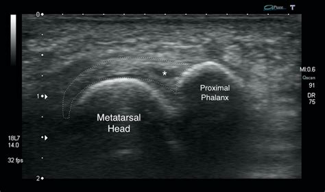 Plantar Plate Tear - Ankle, Foot and Orthotic Centre