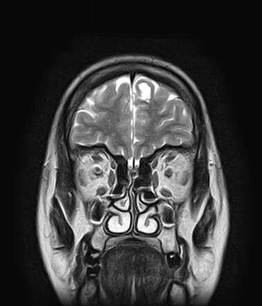 Neuroglial cyst | Image | Radiopaedia.org